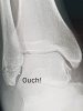 Ankle Fracture 2.jpg